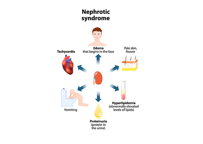Nephrotic Syndrome Treatment | JNU Hospital